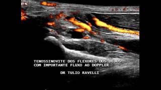 ULTRASSOM DO PUNHO  TENOSSINOVITE DOS TENDÕES FLEXORES DOS DEDOS NO TÚNEL DO CARPO COM DOPPLER [upl. by Eugor]