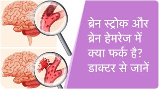 Ischemic vs Hemorrhagic in Hindi ब्रेन स्ट्रोक और ब्रेन हैमरेज में क्या फर्क है डॉक्‍टर से जानें [upl. by Abana]