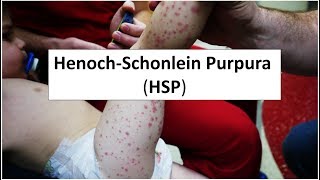 HenochSchonlein Purpura HSP [upl. by Gertrud433]