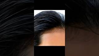 Hair Transplant Me Kitna Paisa Lagta Hai [upl. by Eenolem]