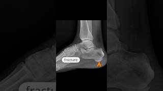 A transverse incomplete nondisplaced fracture of the calcaneus xray [upl. by Deva]