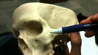 Frontal maxilla and zygomatic bones [upl. by Raimund]