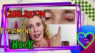 Chalazion Treatment Hack [upl. by Gladis885]