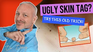 GET RID OF UGLY SKIN TAG 🔴 Tie with a STRING [upl. by Felipe]