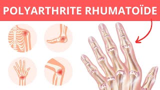 Polyarthrite Rhumatoïde  Symptômes Causes Traitement [upl. by Argile441]