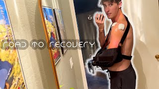 MY SHOULDER LABRUM REPAIR SURGERY RECOVERY [upl. by Oisor]