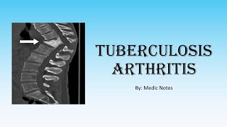 Ortho Tuberculosis arthritis  TB in joints spine TB gibbus deformity investigation treatment [upl. by Sachs]