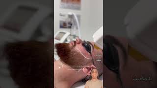 laser hair removal laser hair removal at home laser hair removal on beard [upl. by Charmion]