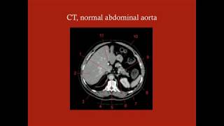 Abdominal Aortic Aneurysm  CRASH Medical Review Series [upl. by Antons]