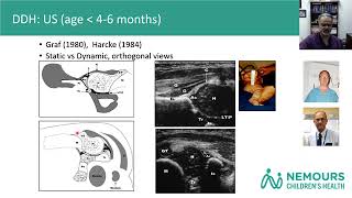 Developmental Dysplasia of the Hip [upl. by Anyl120]