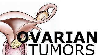 Ovarian Pathology amp Tumors [upl. by Radek123]