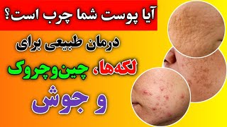 درمان خانگی برای مشکلات پوست صورت  Home remedies for facial skin problems [upl. by Asnarepse]