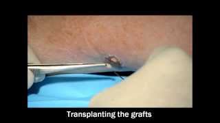 Pinch Skin Grafting [upl. by Earased]