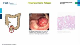 Pathologie ─ Darmerkrankungen [upl. by Kilah66]