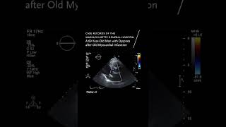 A 69YearOld Man with Dyspnea after Old Myocardial Infarction  NEJM [upl. by Torras]