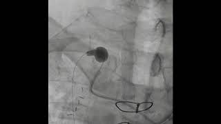 FLASH in RIMA Angioplasty [upl. by Crescin]