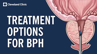 Treating Benign Prostatic Hyperplasia BPH [upl. by Aviv]