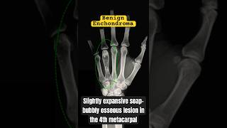 Tumor of the Hand shorts medical bones [upl. by Hawkins]