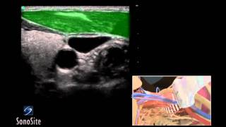 How To Ultrasound Guided Insertion Internal Jugular Catheter Long 3D Video [upl. by Giesser]