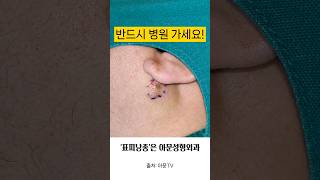 단순 뾰루지인가 귀 표피낭종 피지낭종 핀홀법 수술 성형외과 병원 epidermal epidermoid cyst surgery seoul korea hospital아문TV [upl. by Lemrahc]