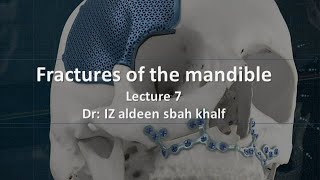 Fractures of the mandible lec 7 part 2  5th stage 2025 [upl. by Ray327]