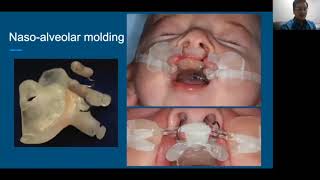 Plastiquest Case Discussion Bilateral Cleft Lip Part 3 [upl. by Nettirb]