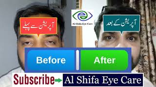 Ptosis Droopy Eyelids Treatment  Jhuki rehne wali palkon ka ilaj in Pakistan [upl. by Nath]