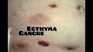 ecthyma causes symptoms and treatment dermatologyskin disease [upl. by Youlton]