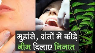 Remove your Pimples amp Get Rid of Cavities with Wonder Herb NEEM  Health Benefits [upl. by Calan]