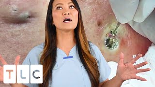 quotThe Award For The Biggest Blackheadquot amp A Juicy Cyst  Dr Pimple Popper This is Zit [upl. by Ramsay]