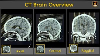 CT Brain Overview  Axial Coronal amp Sagittal [upl. by Allicsirp]