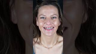 All on 4 Dental Implants in Los Algodones Mexico Lisas Dental Transformation [upl. by Sama]