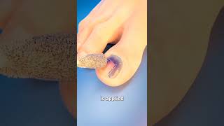 Nail removal creator shorts ytshorts ttending youtube viral [upl. by Nhguavoj]