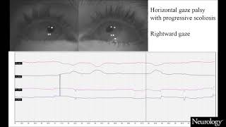 Teaching Video NeuroImages Horizontal gaze palsy with progressive scoliosis [upl. by Yerak525]