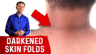 How to Reverse Acanthosis Nigricans [upl. by Folberth]