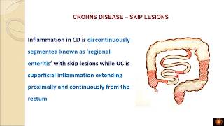 crohns disease Morphology  DrVShanthi [upl. by Boyd]