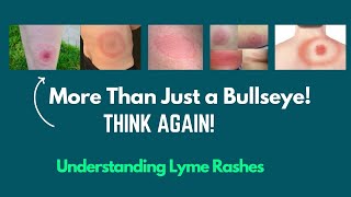 Lyme Disease Rash What Does It Really Look Like [upl. by Nomelihp]