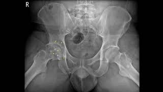 Hip osteoarthritis due to femoral head osteonecrosis [upl. by Slaohcin]