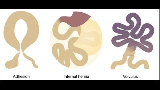 Closed loop obstruction with bowel ischemia  CT findings [upl. by Sillyhp918]