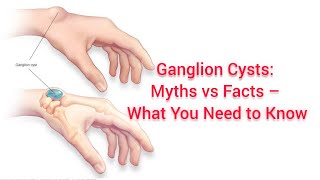 What is a Ganglion Cyst Causes Symptoms and Treatment Explained by a Doctor [upl. by Eciram963]