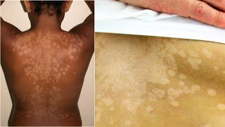 What is Tinea Versicolor Causes Treatment [upl. by Edalb]