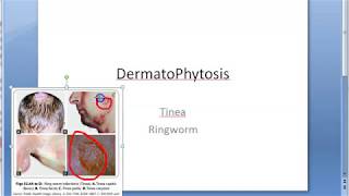 Microbiology 573 a DermatoPhytosis RingWorm Trichophyton Microsporum Epidermophyton ID reaction [upl. by Leacock]