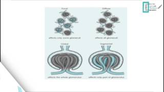 Glomerulonephritis [upl. by Cybil]