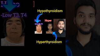 Hypothyroidism vs hyperthyroidism shorts [upl. by Saidee]