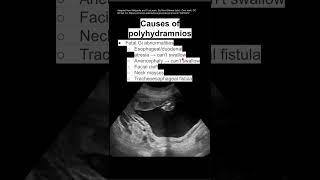 Causes of polyhydramnios [upl. by Eadie988]