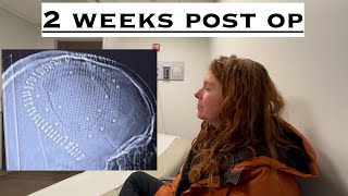 My experience so far 2 weeks after craniotomy surgery for removal of a brain tumor Part 4 [upl. by Lennaj702]