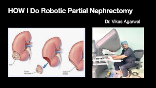 Robotic Partial nephrectomy for left lower pole kidney tumor [upl. by Waddle892]