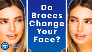 Do Braces Change Your Face  The Impact Of Braces On Your Jawline amp Face Shape [upl. by Palumbo543]