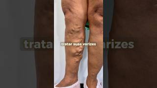 safena varizes clinicavascular varizes angiologista endolaser bahia feiradesantana [upl. by Orhtej71]