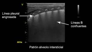 Pleura Engrosada [upl. by Itsym262]